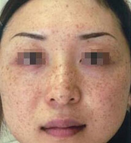 黄褐斑早期的症状主要有哪些呢