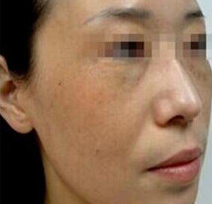 黄褐斑症状和按照生长部位分型