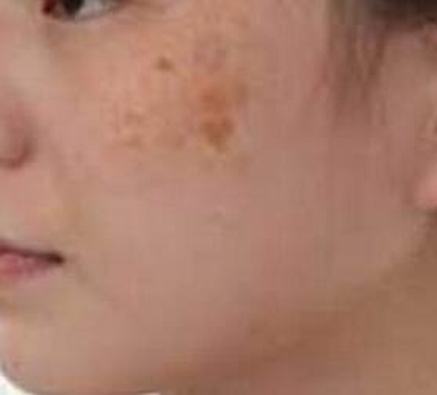 介绍黄褐斑的治疗的手法