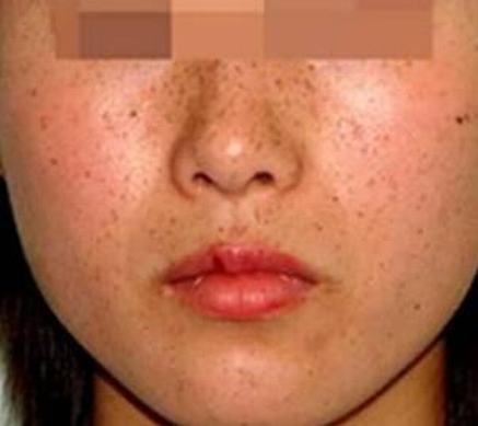 面部黄褐斑的症状是什么