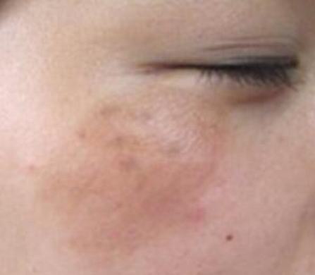面部长黄褐斑症状有什么