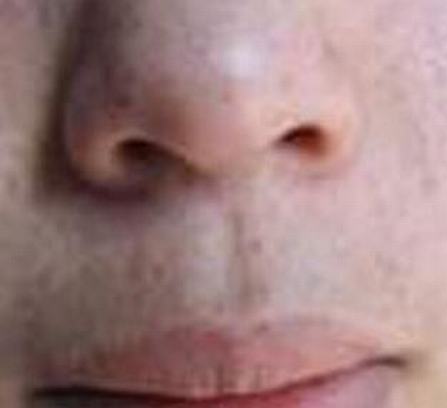 女性更年期怎样的预防黄褐斑