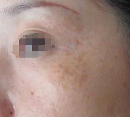 更年期的女性怎样的预防黄褐斑