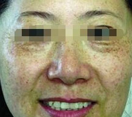 要是得上黄褐斑都有哪些表现呢