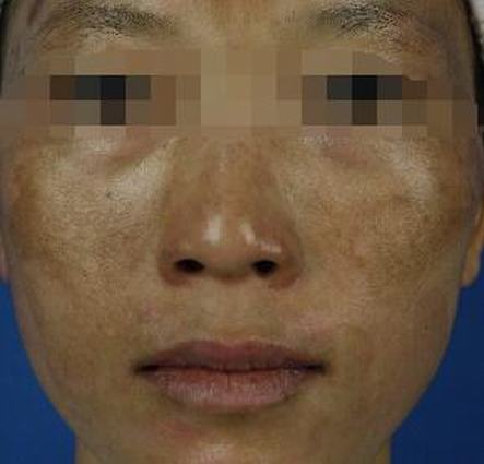 怎么才可以祛黄褐斑科学呢