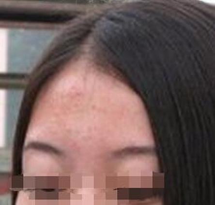 中医黄褐斑的划分