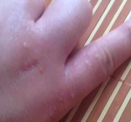 皮肤科医院疥疮是哪些因素诱发的