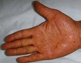 青岛皮肤病研究院治疗手足癣哪里好