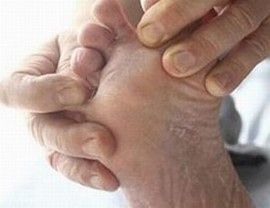 手足癣症状有什么特点