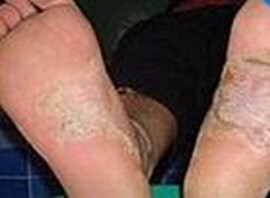 手足癣这种疾病有什么伤害