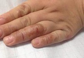 手足癣怎样预防呢