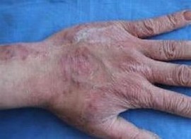 手足癣有哪些致病因素