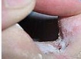 手足癣应怎样的预防