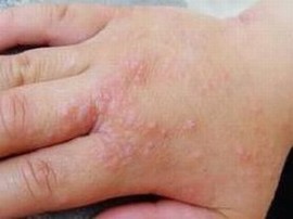 手足癣我们应该如何治疗