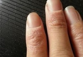 手足癣危害大赶紧治疗是关键