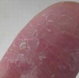 手足癣是怎样的皮肤病
