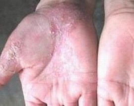 手足癣是怎样的疾病呢