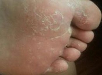 怎么区分鉴别手足癣