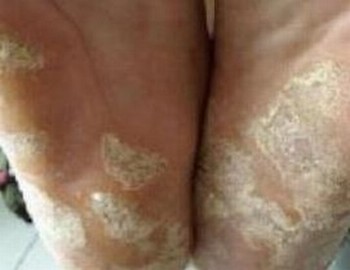 孕妇患手足癣要如何治疗