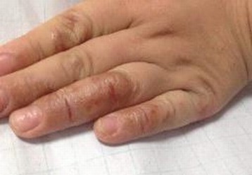 专家解析水疱型手癣图片