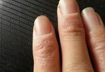 小小手足癣可能引起哪些大病