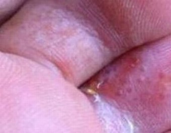 夏季要留意避免发生手足癣