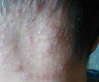 股癣有哪些发病特点
