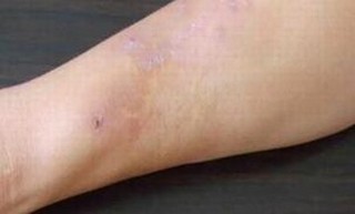 专家来对什么是泛发性体癣进行介绍