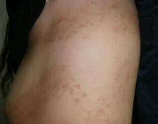 专家为您介绍体癣三大症状