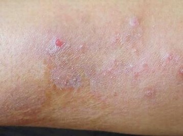 体癣一般容易和哪些皮肤病混淆呢