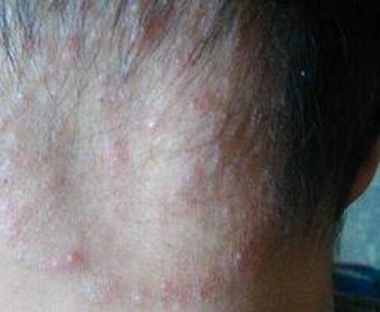 体癣预防注意什么