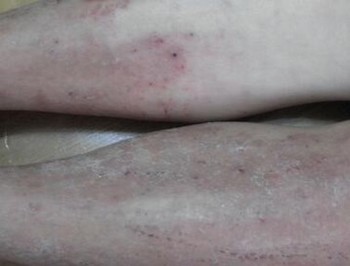 体癣怎样预防