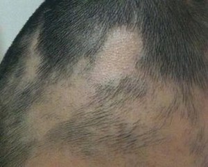 小孩得头癣掉皮怎么办