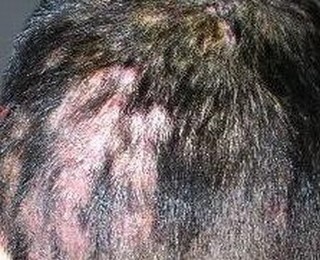 头癣有什么治疗的手法