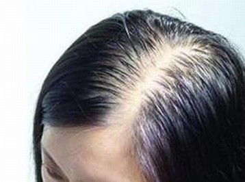 关于怎样的预防脱发的小知识