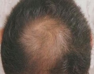 男性人群如何防治脂溢性脱发