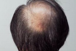 男性脱发病因有什么毛囊管理系统治疗脱发
