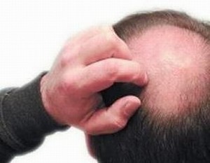 男性脱发的病因有什么