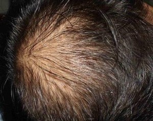 男性脱发的原因一般都有什么呢