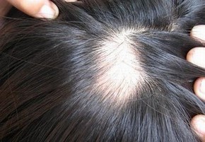 女性朋友如何有效的预防脱发