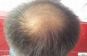女性脱发七大病因