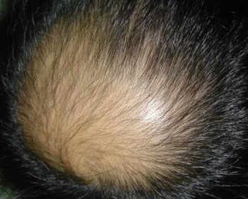 急慢性脂溢性脱发的不同表现