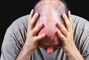 检查脱发需要哪几种检查