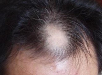 青岛哪个医院脱发看的比较好