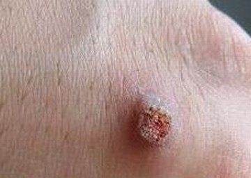 治疗寻常疣的偏方