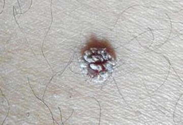 治疗刺猴措施