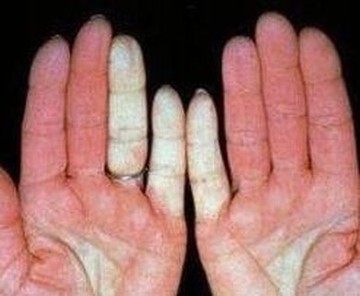 硬皮病患者多缺乏维生素A