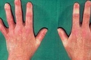 硬皮病患者该怎么自我护理