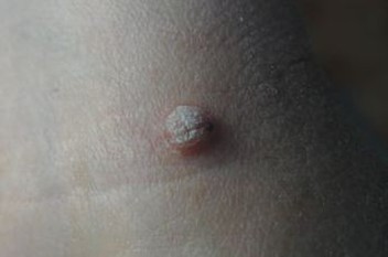 寻常疣的发病病因有什么 