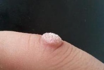 寻常疣对身体有什么损害